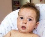 Desensitization Useful for Allergy to Life-Saving Drug