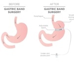Bariatric surgery may be an effective treatment for obese people at risk of diabetes, peripheral neuropathy