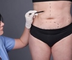 Weight loss surgery leads to significant boost in self esteem