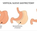 New study links social factors to racial disparities in weight loss surgery outcomes