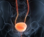 Chemotherapy may trigger inflammatory response that fuels bladder cancer resistance