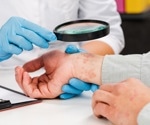 New murine model sheds light on anti-MDA5 antibody-positive dermatomyositis