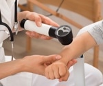 New index helps optimize picosecond laser treatment for nevus of Ota