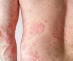 Bias found in AI models diagnosing skin diseases across demographics