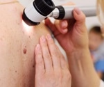 Novel treatment for inflammatory skin conditions could be on the horizon
