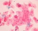 Cervical cancer during pregnancy linked to higher maternal health risks