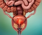 Study suggests ways to prevent prostate cancer