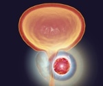 New online prostate calculator