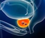 Study reveals how FOXA1 mutations drive prostate cancer and therapy resistance