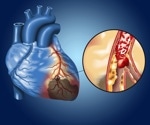 Study discovers link between a breakdown product from excess niacin and heart disease