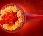 Monash-led research highlights urgent need to redefine PCOS