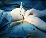 New hot-melt tissue adhesive can heal operative wounds
