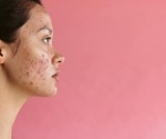 Accure Acne secures FDA clearance for long-term acne solution