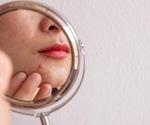 Microneedling more effective than chemical peels for treating acne scars in patients with dark skin
