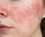 Individuals with acne face stigmatizing attitudes from the general public, study finds