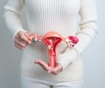 Low FODMAP diet shown to improve gastrointestinal symptoms in women with endometriosis