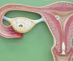 Endometriosis and uterine fibroids may raise risk of early death in women